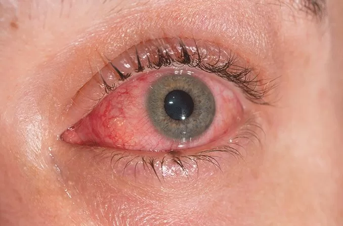 conjunctivitis-pink-eye-collected